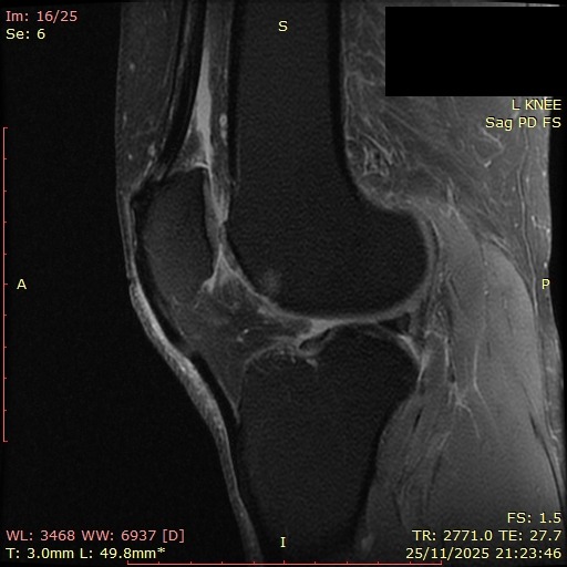 MRI sagittal view, αριστερό γόνατο, sequence Sag PD FS, ρήξη μηνίσκου Νοέμβριος 2025
